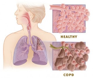 Copd_versus_healthy_lung